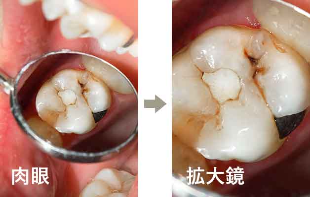 歯科用拡大ルーペとは