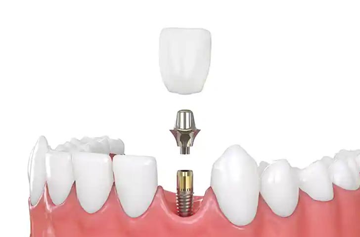 一般的な歯の治療