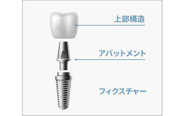 インプラントの構造