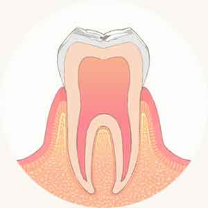 初期虫歯
