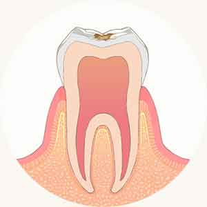 エナメル質の虫歯