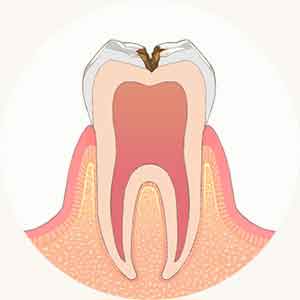 象牙質の虫歯