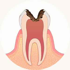 神経に達する虫歯