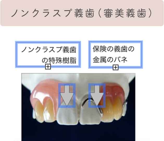 ノンクラスプ義歯（審美義歯）
