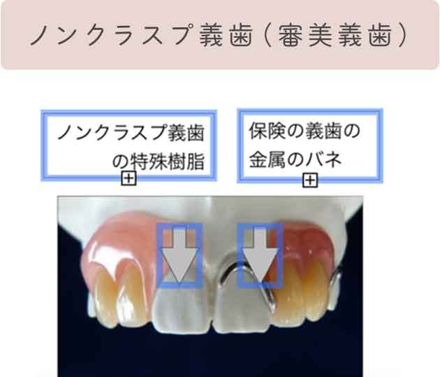 ノンクラスプ義歯(審美義歯)