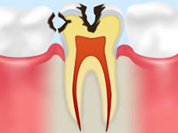 神経に近い象牙質の虫歯