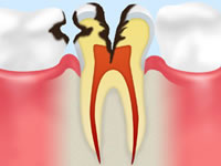 神経に達する虫歯