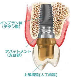 インプラント